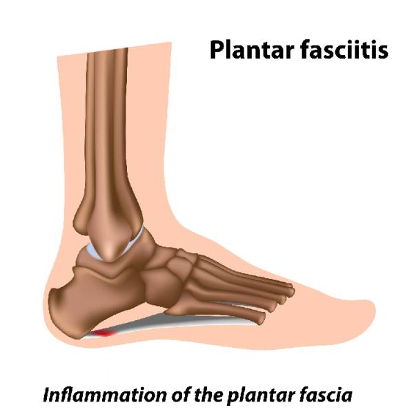 plantar fasciitis, cupping for plantar fasciitis