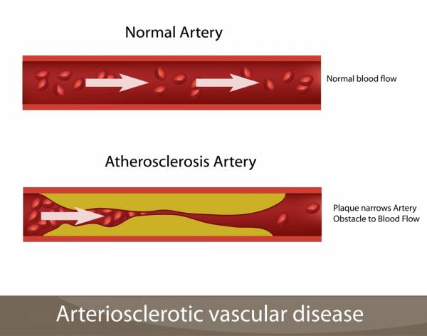 plaque build up, plaque formation, adiponectin, excess body fat