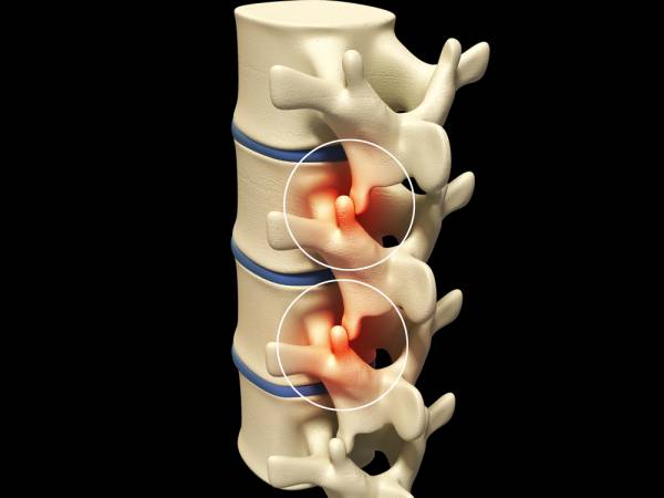 lumbar spine, facet, facet syndrome