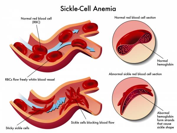 https://pulsebeatfit.com/health-medicine/understanding-sickle-cell-trait-and-pr