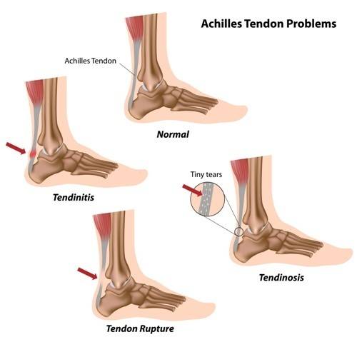 achilles, achilles tendon, achilles injuries, foot injuries