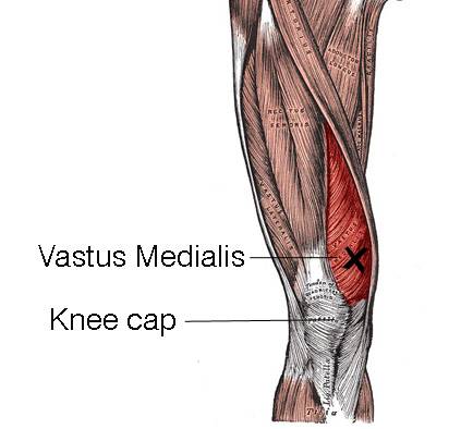 vastus medialis