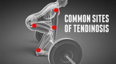 tendinitis is often inaccurately diagnosed