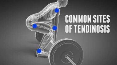 tendinosis