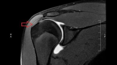 shoulder MRI